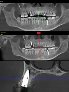 邏女士殘根即拔即種案例